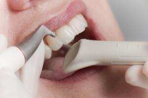 Dental scale and polish in Javea