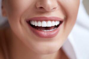 Dental veneers in Javea