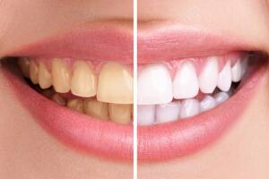 Teeth whitening in Javea - White teeth