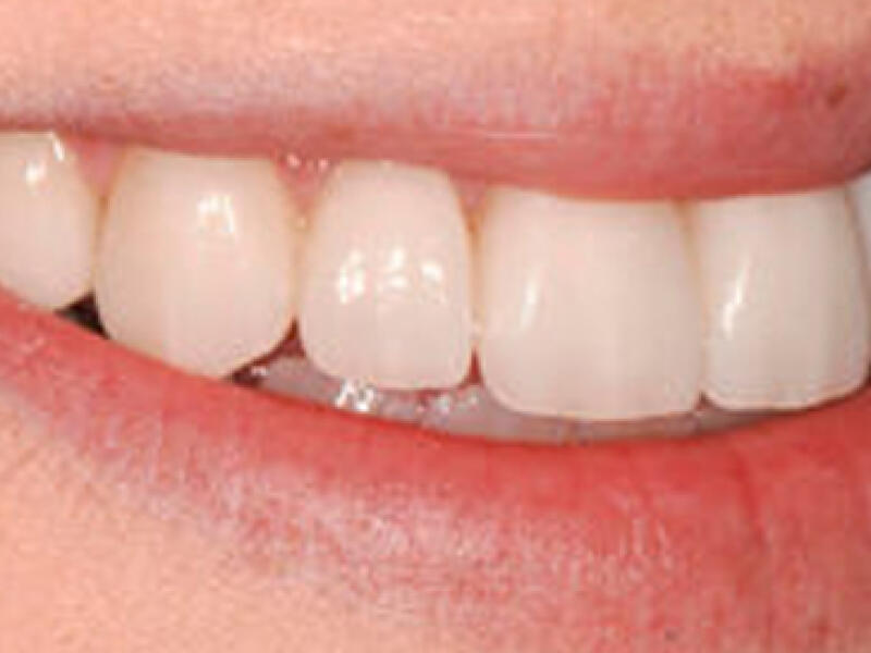 After image